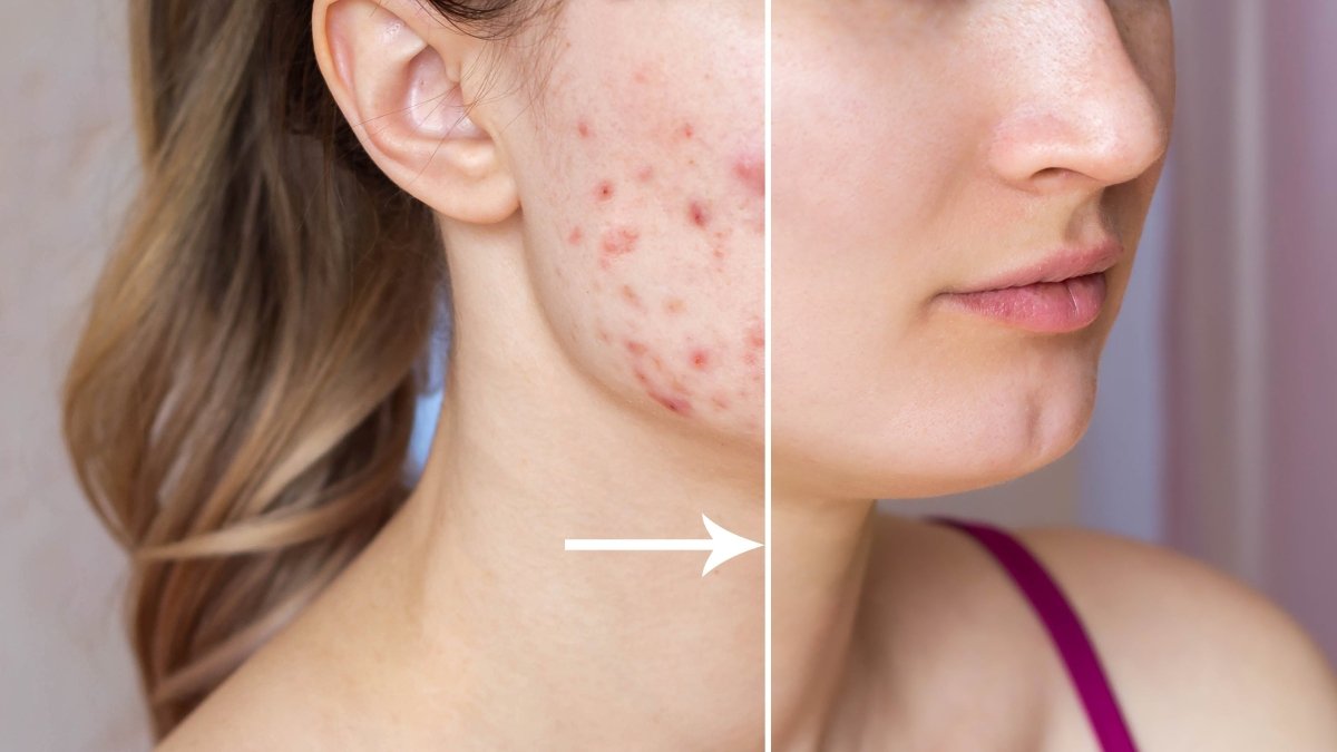 Clear Skin Without Accutane? Why a Consistent Acne Program Should Come First - Sonder Beauty Studio