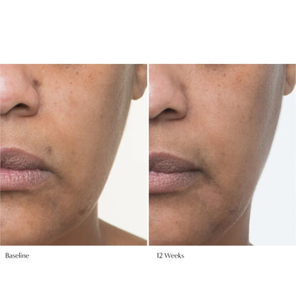 Le Prunier Plumscreen Before and After