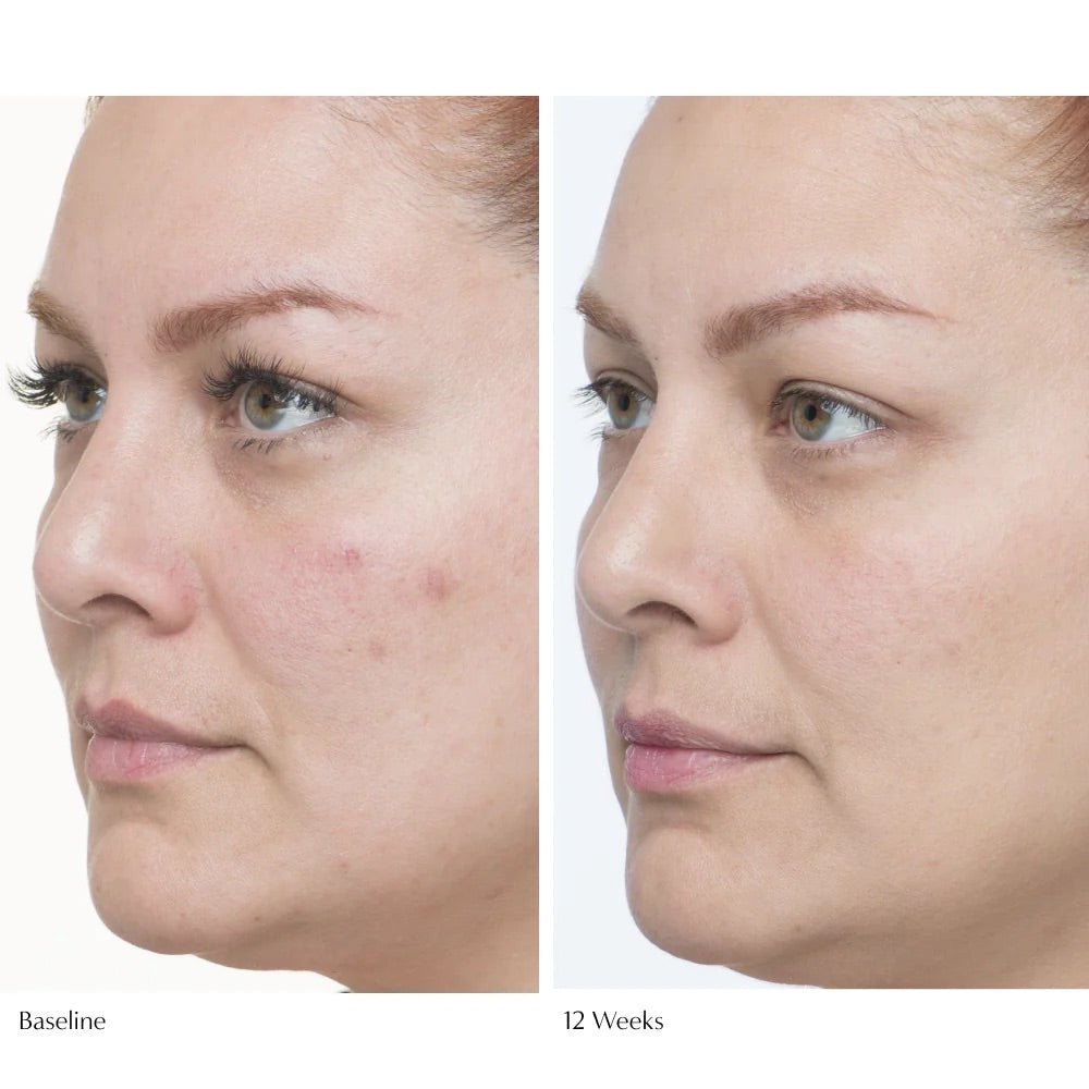 Le Prunier Plumscreen Before and After Woman