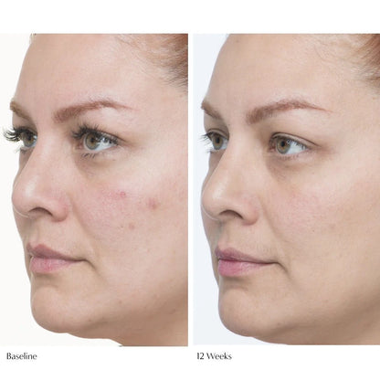 Le Prunier Plumscreen Before and After Woman